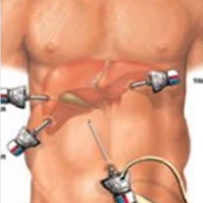 Imagem-interna-Videocirurgia-(Videolaparoscopia)